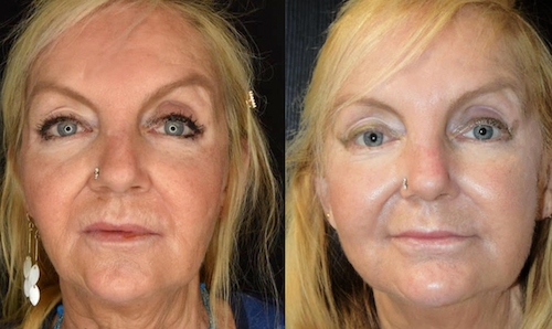 non surgical facelift results before after lip doctor mississauga oakville